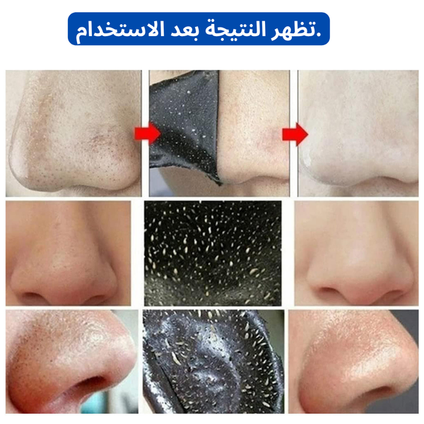 شرائط الأنف الشفافة بالفحم
