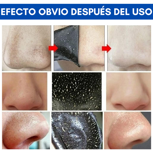 Tiras Nasales Claras de Carbón