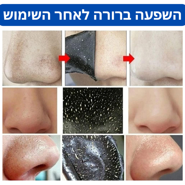 רצועות אף לניקוי נקודות שחורות פחם